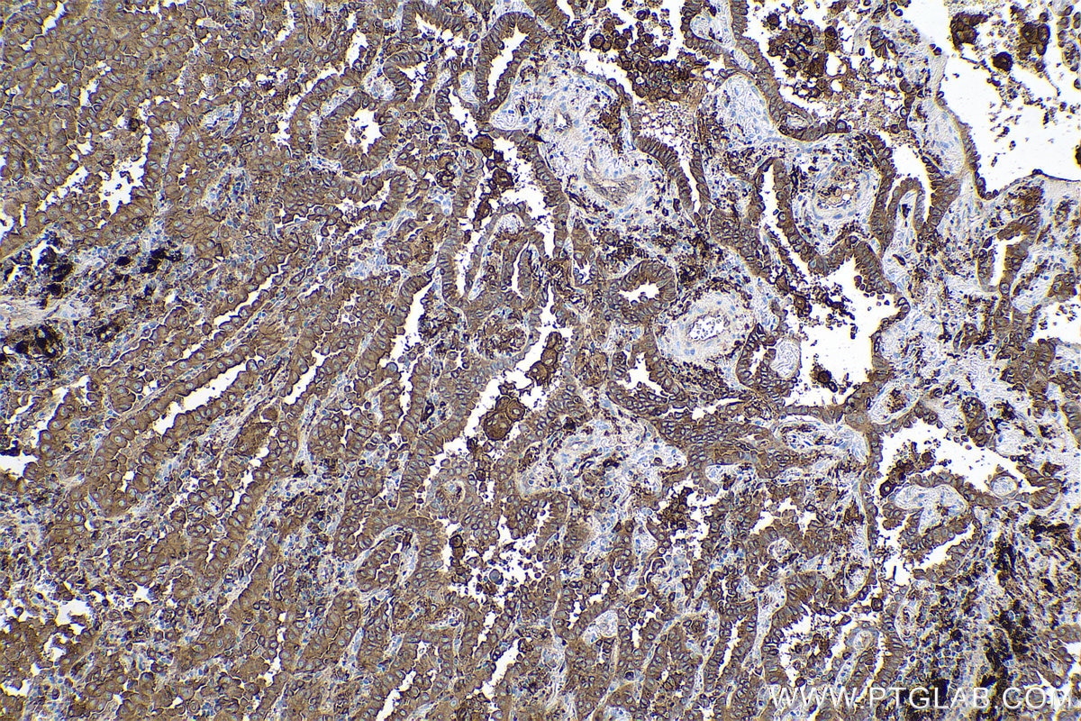 Immunohistochemical analysis of paraffin-embedded human lung cancer tissue slide using KHC0623 (HLA-DRB1 IHC Kit).