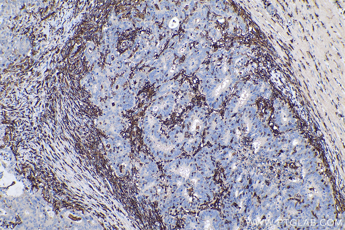 Immunohistochemical analysis of paraffin-embedded human colon cancer tissue slide using KHC0623 (HLA-DRB1 IHC Kit).