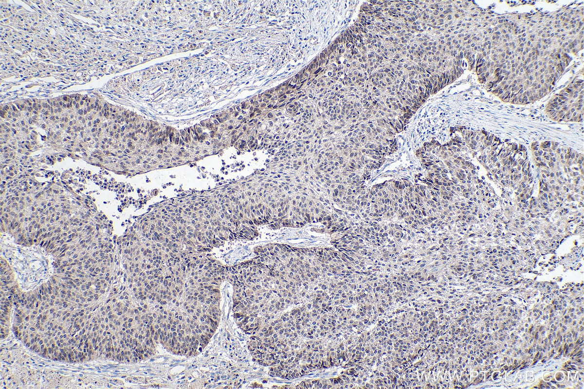 Immunohistochemical analysis of paraffin-embedded human lung cancer tissue slide using KHC0265 (HMGA2 IHC Kit).