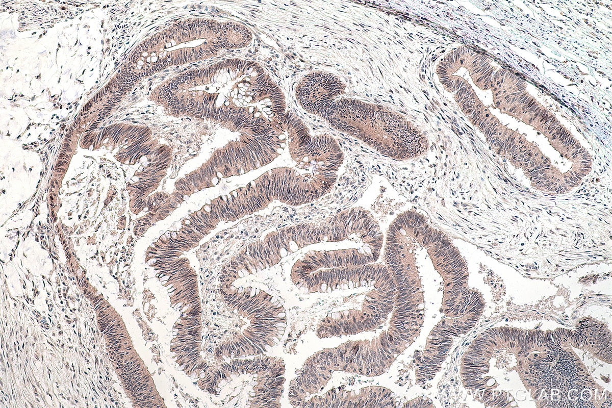 Immunohistochemical analysis of paraffin-embedded human colon cancer tissue slide using KHC0265 (HMGA2 IHC Kit).