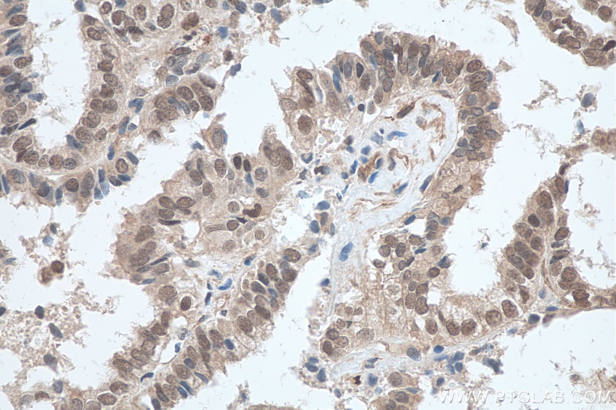 Immunohistochemical analysis of paraffin-embedded human ovary tumor tissue slide using KHC0736 (HMGB1 IHC Kit).