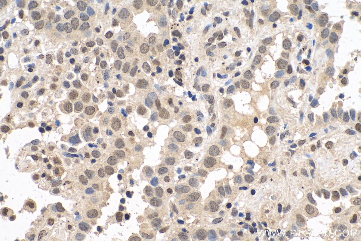 Immunohistochemical analysis of paraffin-embedded human lung cancer tissue slide using KHC0723 (HMGB2 IHC Kit).