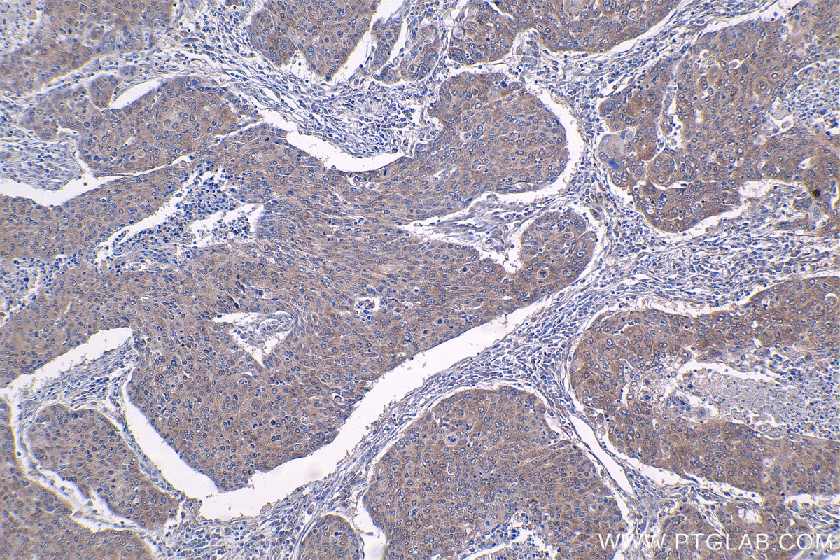 Immunohistochemical analysis of paraffin-embedded human lung cancer tissue slide using KHC1410 (HMGN1 IHC Kit).