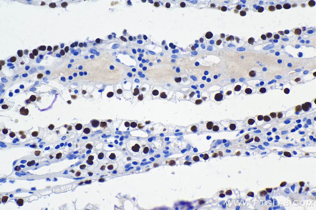 Immunohistochemical analysis of paraffin-embedded human renal cell carcinoma tissue slide using KHC1100 (HNF1B IHC Kit).