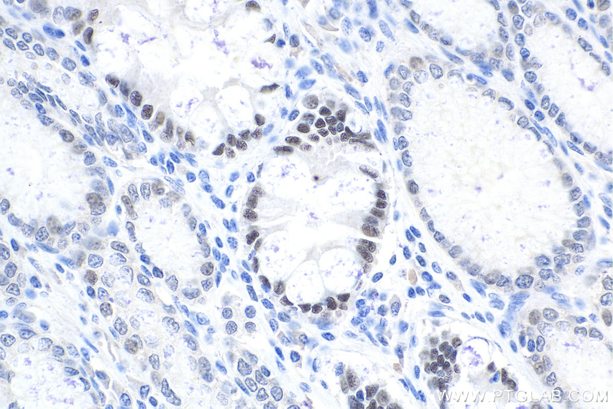 Immunohistochemical analysis of paraffin-embedded human stomach cancer tissue slide using KHC1733 (HNF4G IHC Kit).