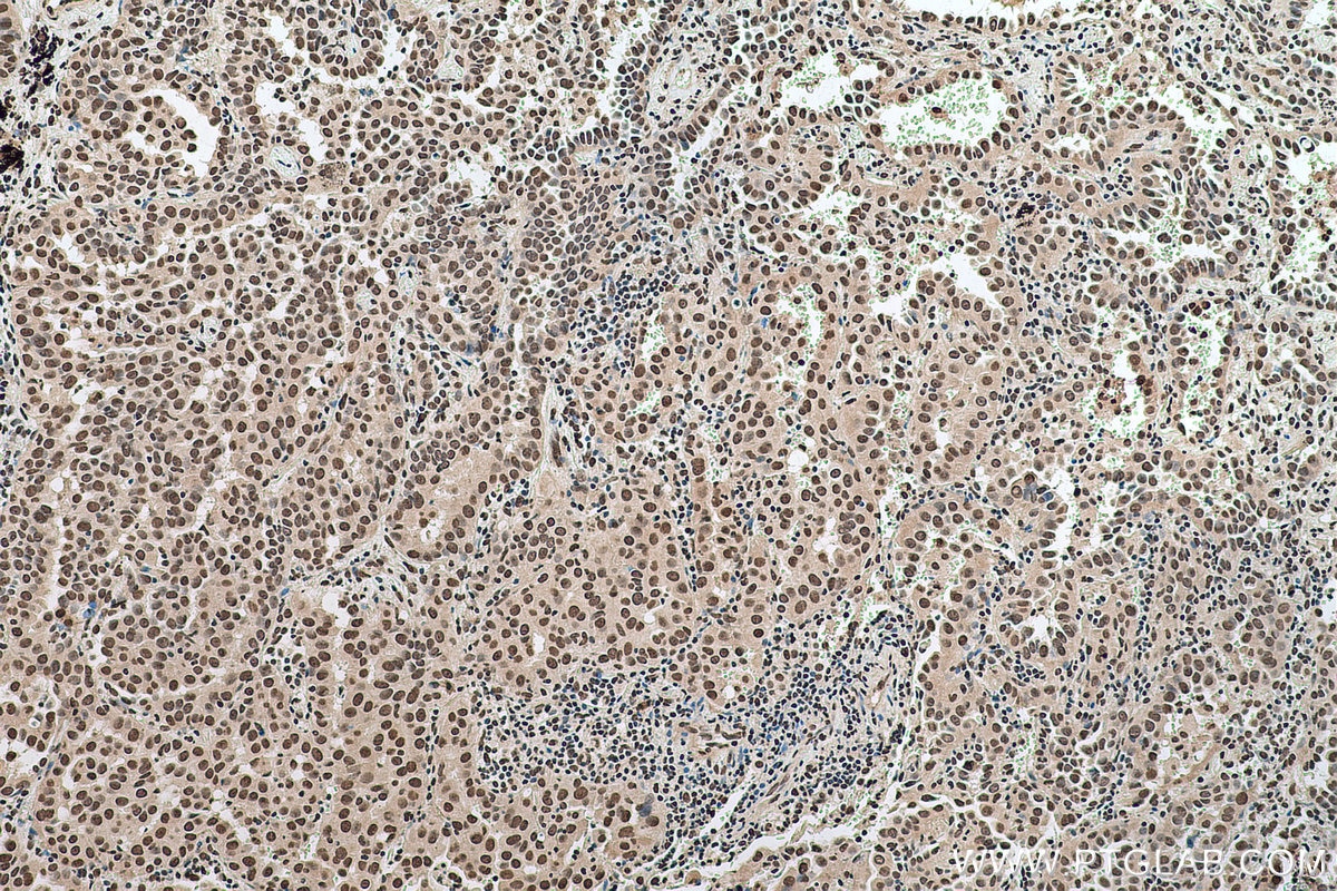 Immunohistochemical analysis of paraffin-embedded human lung cancer tissue slide using KHC0682 (HNRNPA1 IHC Kit).