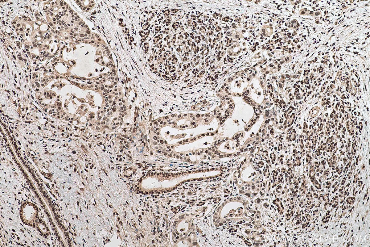 Immunohistochemical analysis of paraffin-embedded human pancreas cancer tissue slide using KHC0682 (HNRNPA1 IHC Kit).