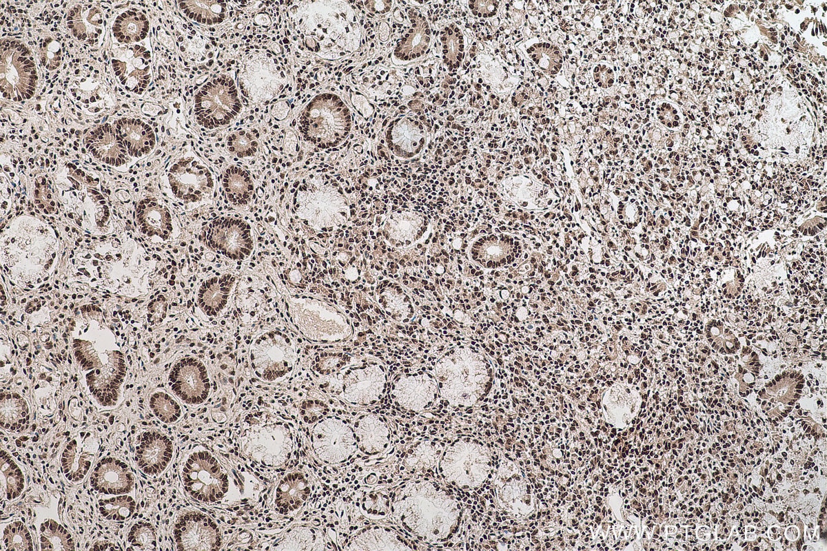Immunohistochemical analysis of paraffin-embedded human stomach cancer tissue slide using KHC0682 (HNRNPA1 IHC Kit).