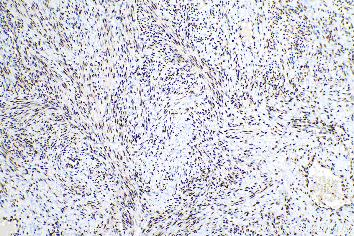 Immunohistochemical analysis of paraffin-embedded human cervical cancer tissue slide using KHC0163 (HNRNPA2B1 IHC Kit).