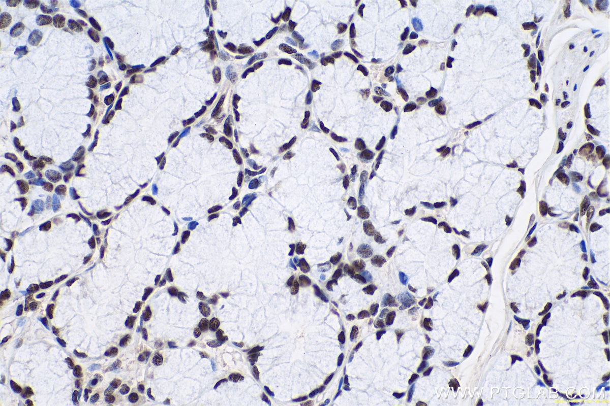 Immunohistochemical analysis of paraffin-embedded human stomach cancer tissue slide using KHC0657 (HNRNPA3 IHC Kit).