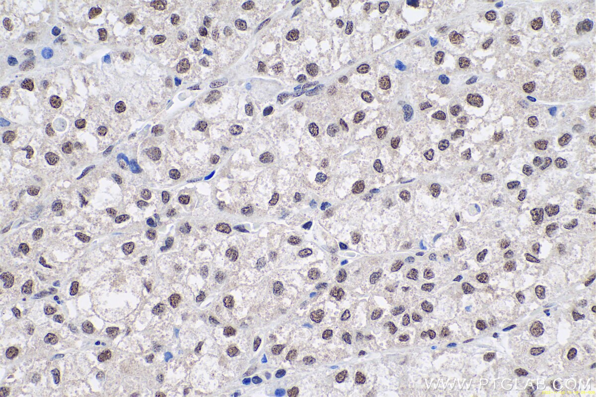 Immunohistochemical analysis of paraffin-embedded human liver cancer tissue slide using KHC0657 (HNRNPA3 IHC Kit).