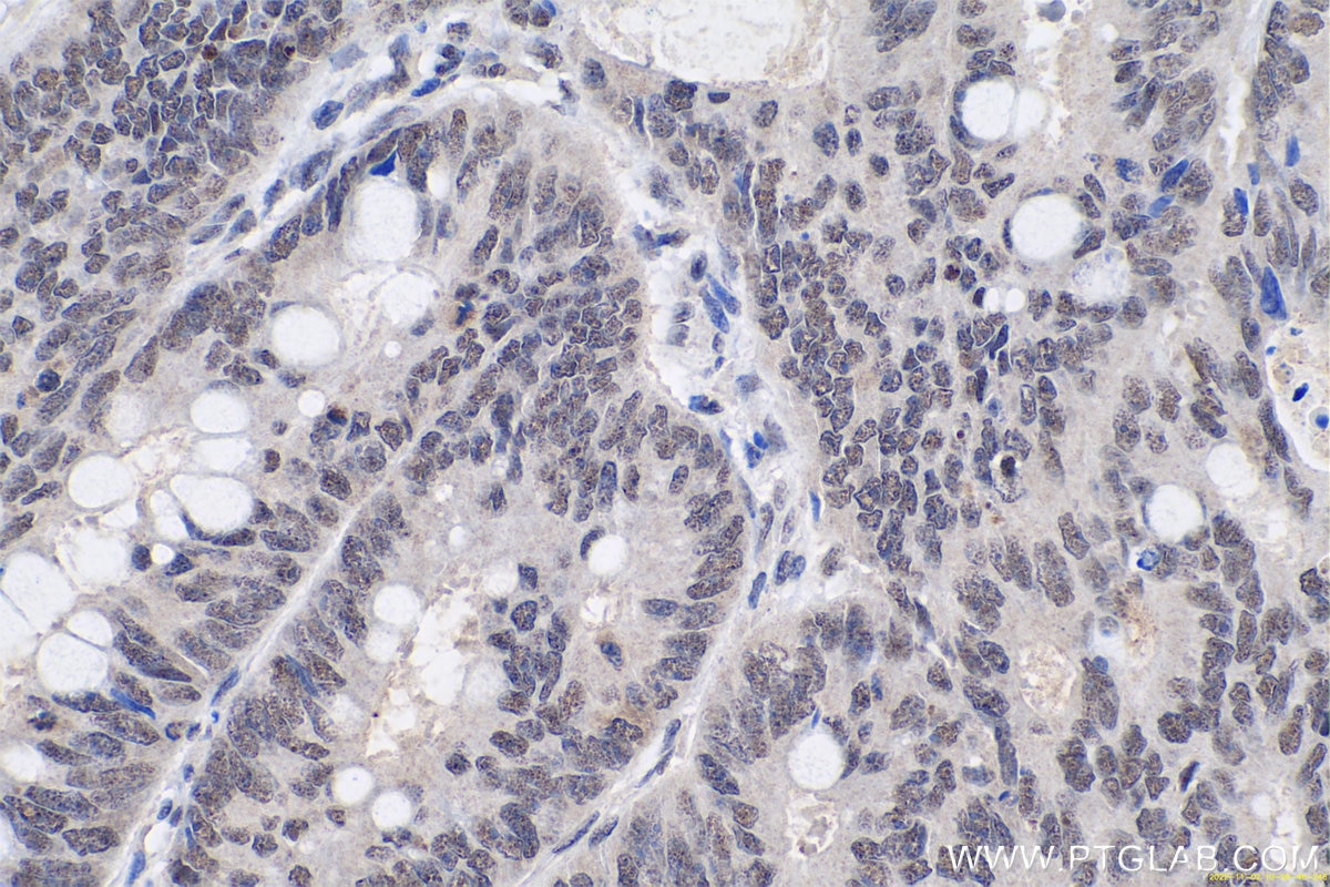 Immunohistochemical analysis of paraffin-embedded human colon cancer tissue slide using KHC0657 (HNRNPA3 IHC Kit).