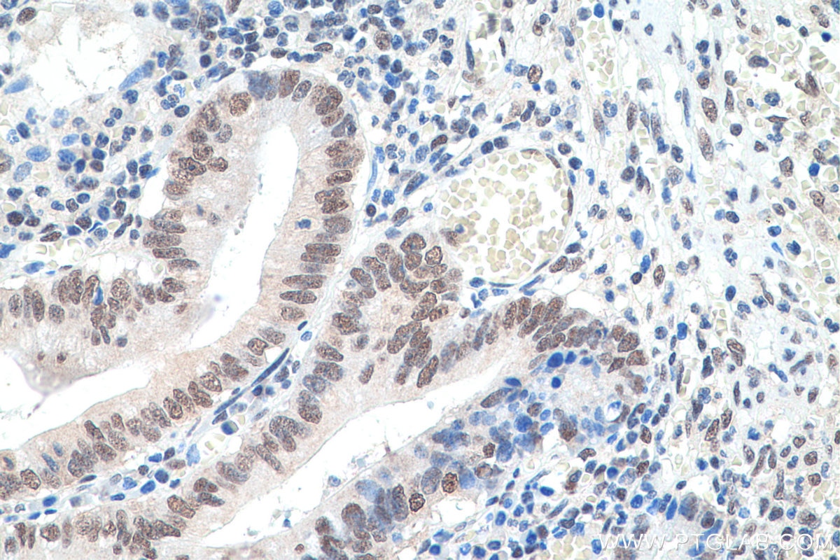 Immunohistochemical analysis of paraffin-embedded human appendicitis tissue slide using KHC0657 (HNRNPA3 IHC Kit).