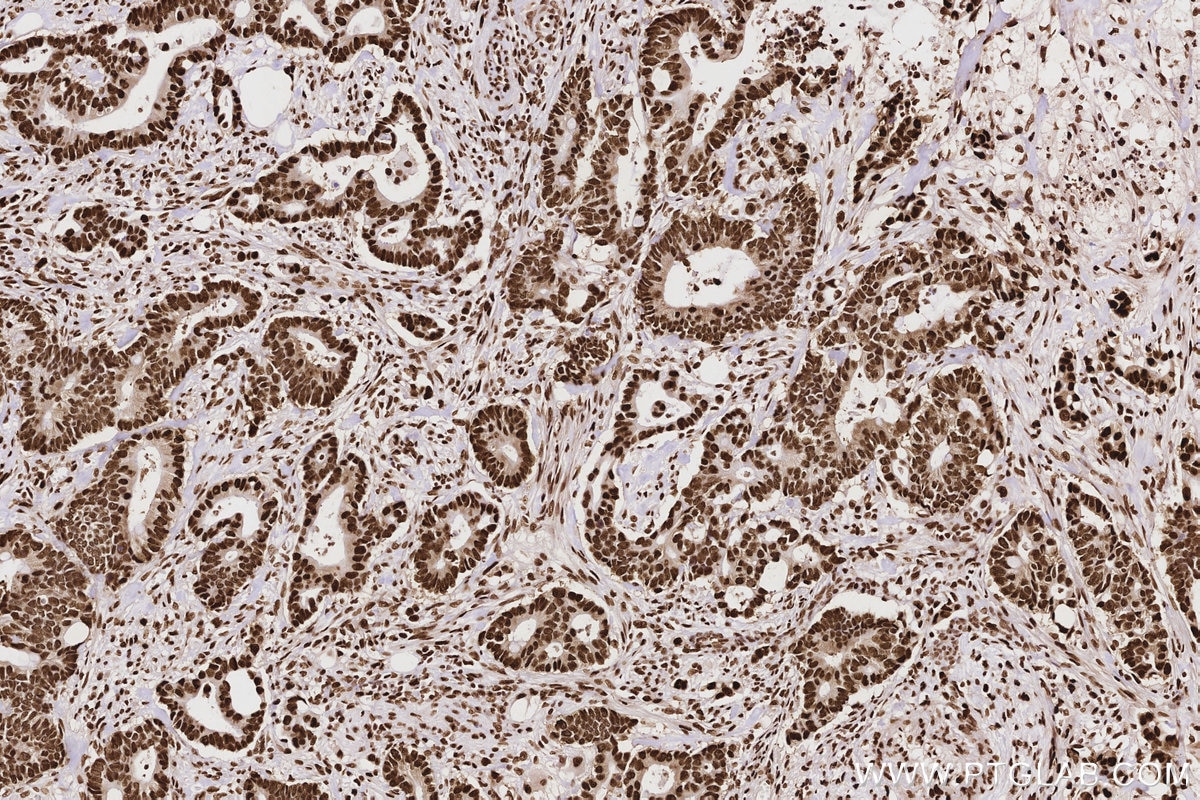 Immunohistochemical analysis of paraffin-embedded human rectal cancer tissue slide using KHC2847 (HNRNPAB IHC Kit).