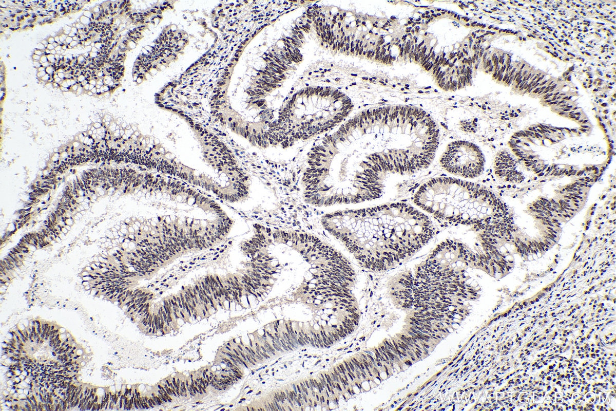 Immunohistochemical analysis of paraffin-embedded human colon cancer tissue slide using KHC0164 (HNRNPC IHC Kit).