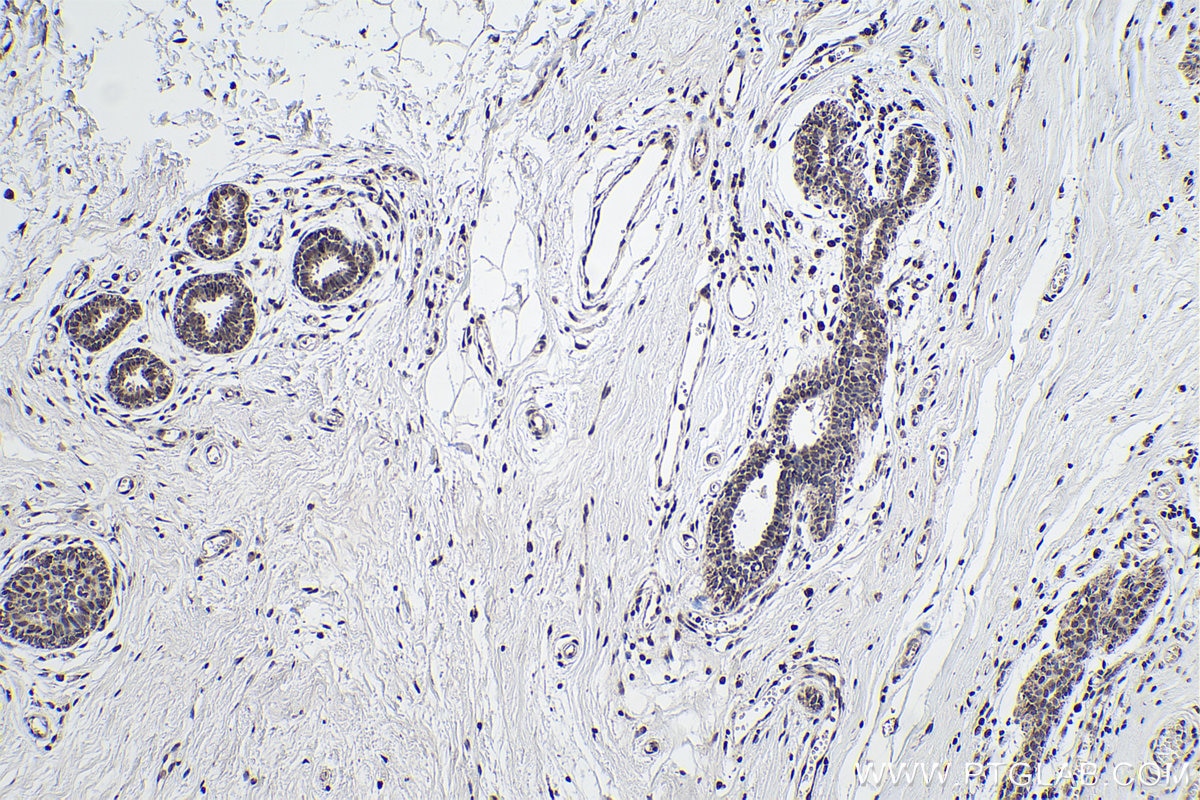 Immunohistochemical analysis of paraffin-embedded human breast cancer tissue slide using KHC0164 (HNRNPC IHC Kit).