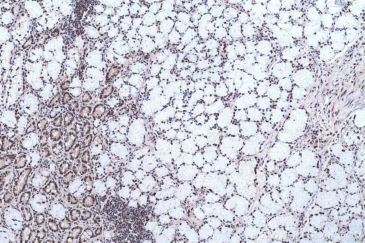 Immunohistochemical analysis of paraffin-embedded human stomach cancer tissue slide using KHC0663 (HNRNPD IHC Kit).