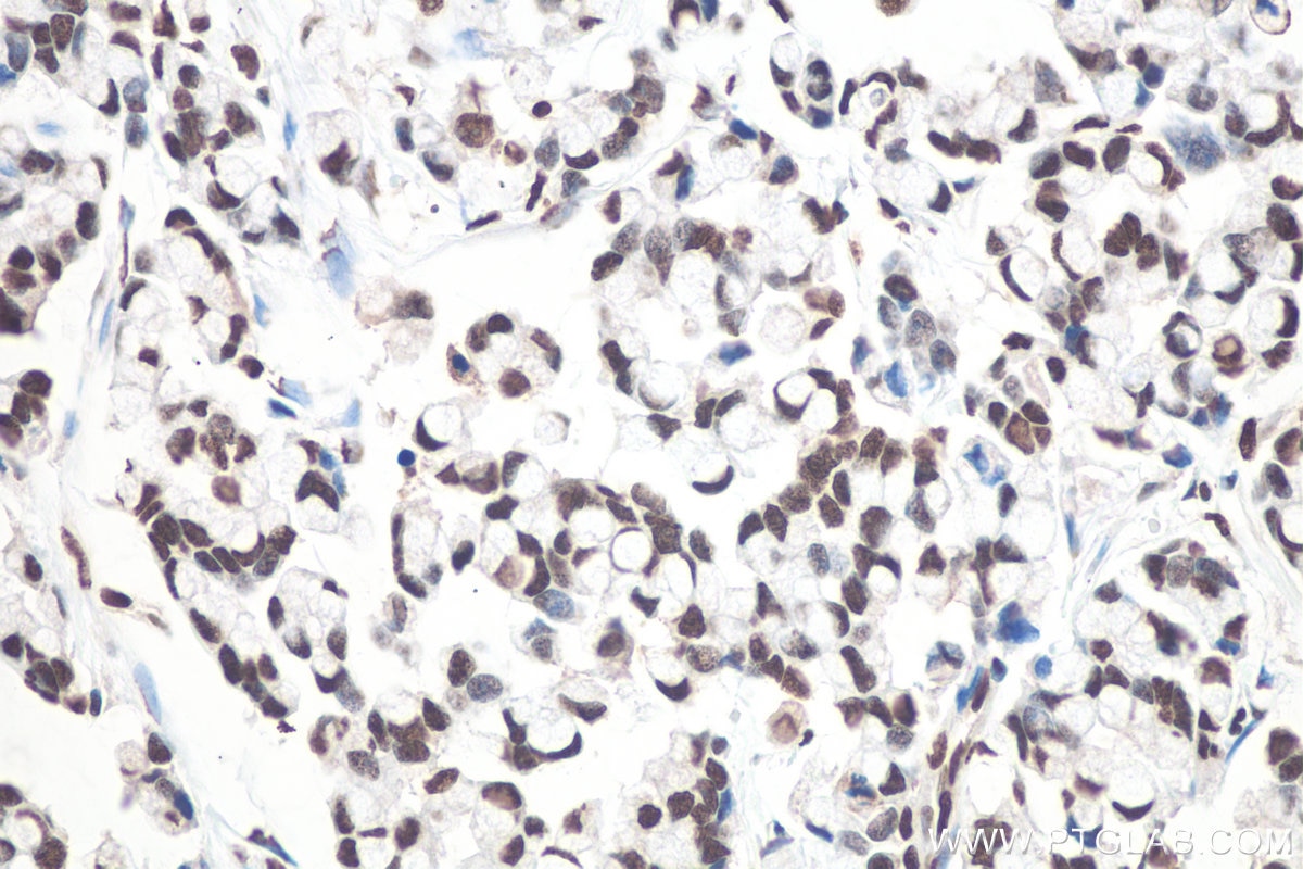 Immunohistochemical analysis of paraffin-embedded human colon cancer tissue slide using KHC0663 (HNRNPD IHC Kit).