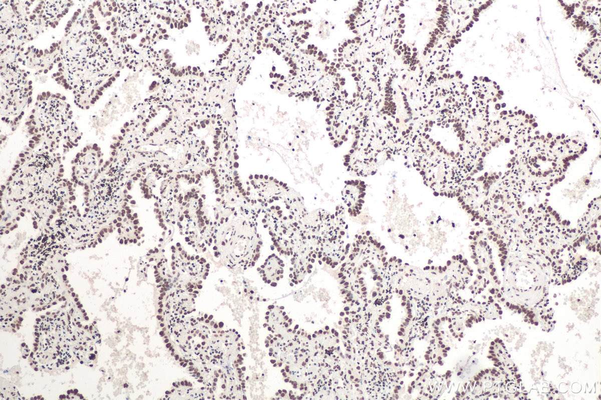 Immunohistochemical analysis of paraffin-embedded human lung cancer tissue slide using KHC0663 (HNRNPD IHC Kit).