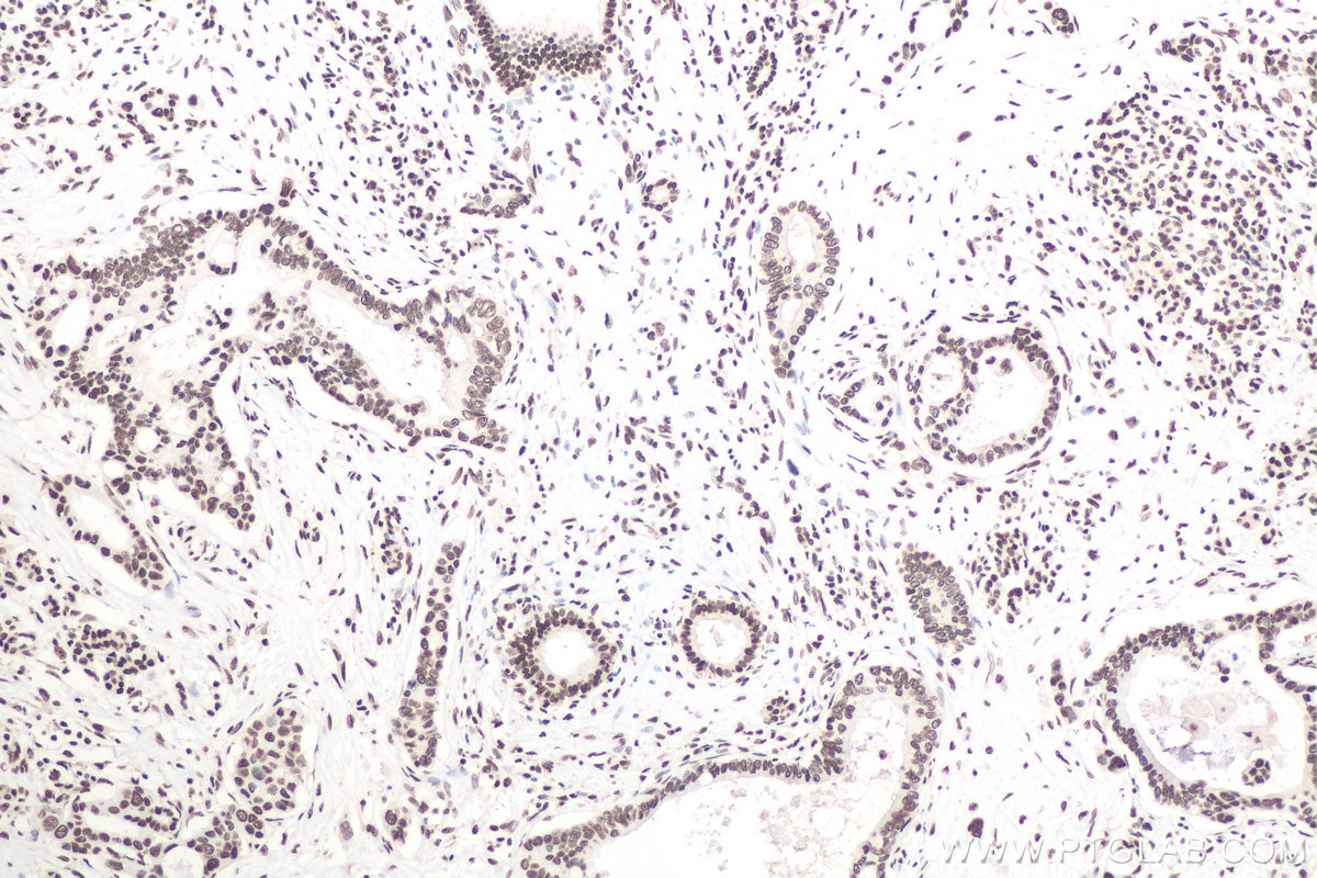 Immunohistochemical analysis of paraffin-embedded human pancreas cancer tissue slide using KHC0663 (HNRNPD IHC Kit).