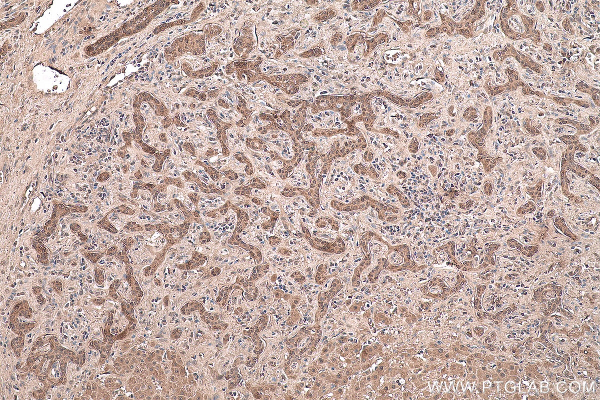 Immunohistochemical analysis of paraffin-embedded human liver cancer tissue slide using KHC0590 (HNRNPK IHC Kit).