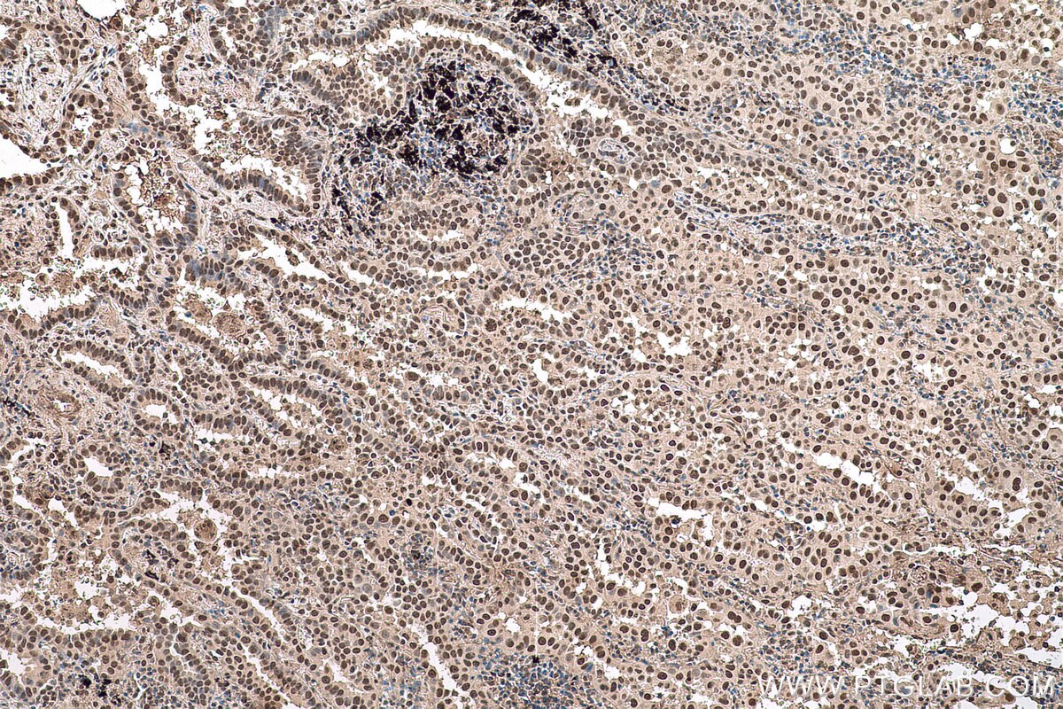 Immunohistochemical analysis of paraffin-embedded human lung cancer tissue slide using KHC0590 (HNRNPK IHC Kit).