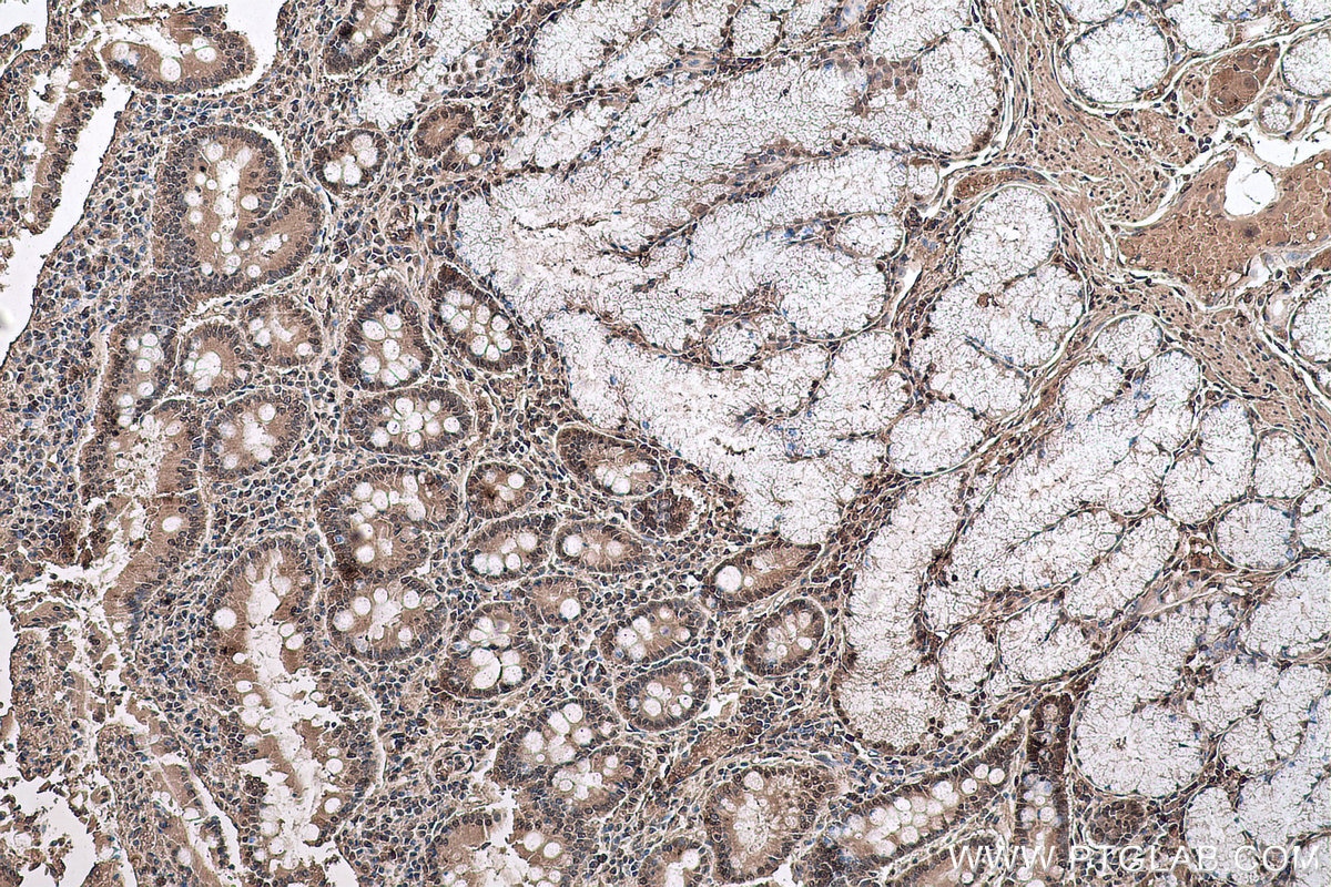Immunohistochemical analysis of paraffin-embedded human stomach cancer tissue slide using KHC0590 (HNRNPK IHC Kit).