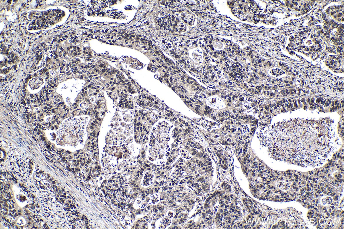 Immunohistochemical analysis of paraffin-embedded human stomach cancer tissue slide using KHC1386 (HNRNPL IHC Kit).