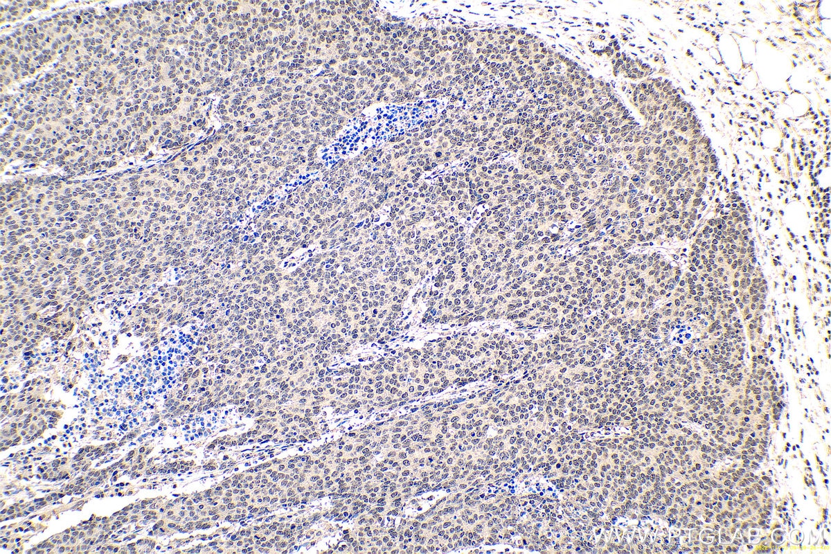 Immunohistochemical analysis of paraffin-embedded human colon cancer tissue slide using KHC0669 (HNRNPU IHC Kit).
