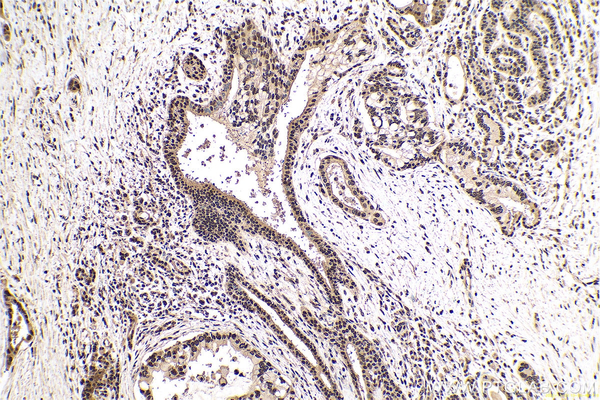 Immunohistochemical analysis of paraffin-embedded human pancreas cancer tissue slide using KHC0669 (HNRNPU IHC Kit).