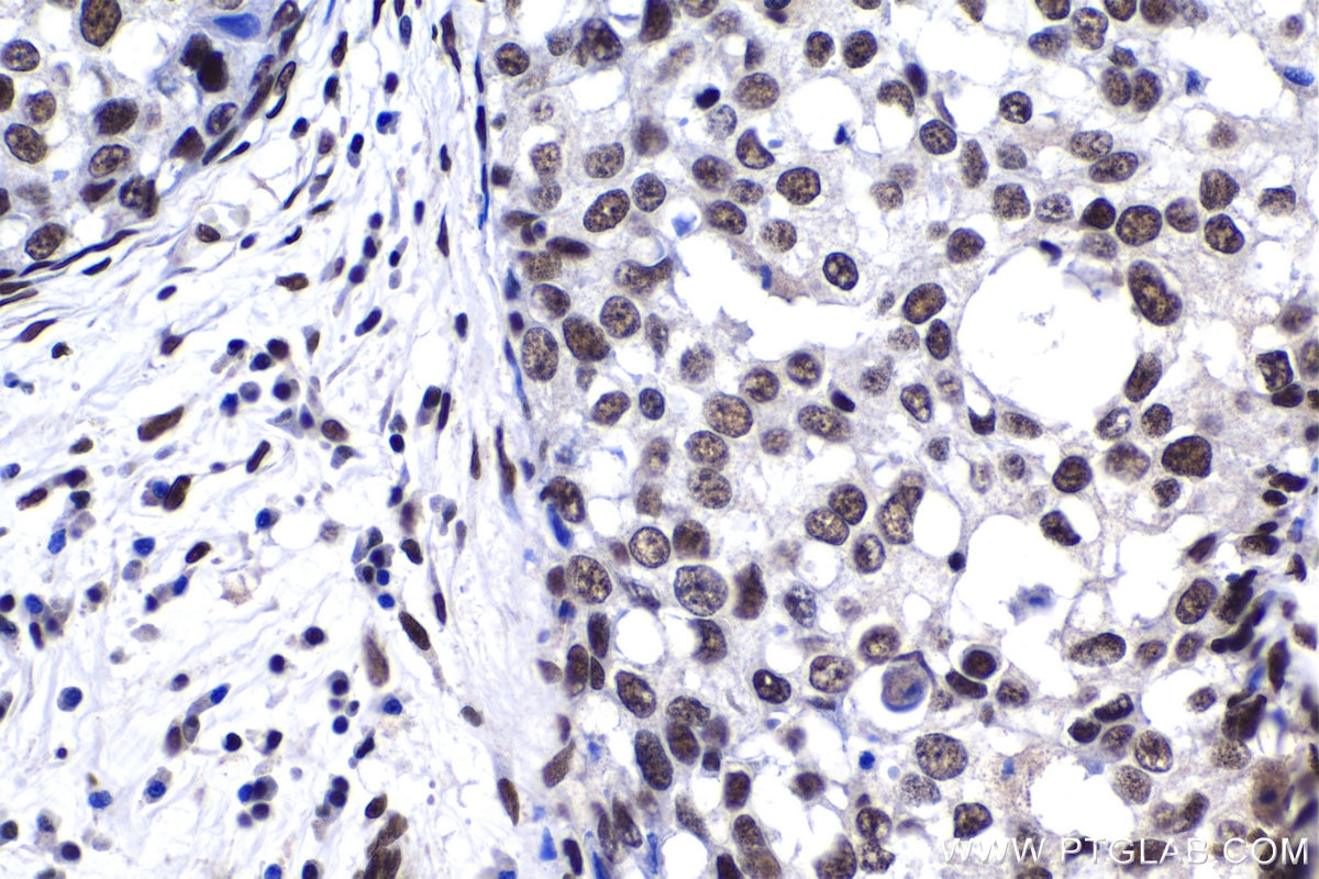 Immunohistochemical analysis of paraffin-embedded human breast cancer tissue slide using KHC1387 (HNRNPUL1 IHC Kit).