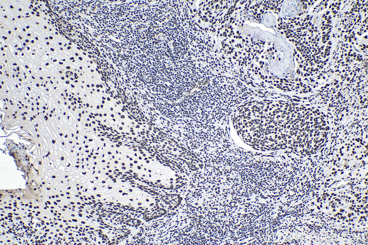 Immunohistochemical analysis of paraffin-embedded human oesophagus cancer tissue slide using KHC1387 (HNRNPUL1 IHC Kit).