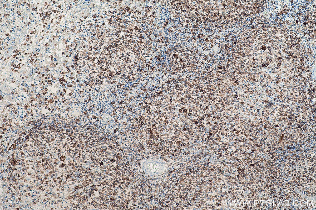 Immunohistochemical analysis of paraffin-embedded human lymphoma tissue slide using KHC0624 (HO-1/HMOX1 IHC Kit).