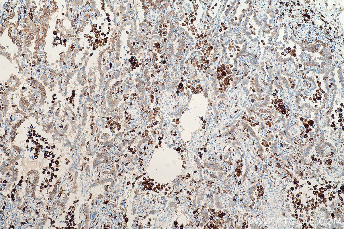 Immunohistochemical analysis of paraffin-embedded human lung cancer tissue slide using KHC0624 (HO-1/HMOX1 IHC Kit).