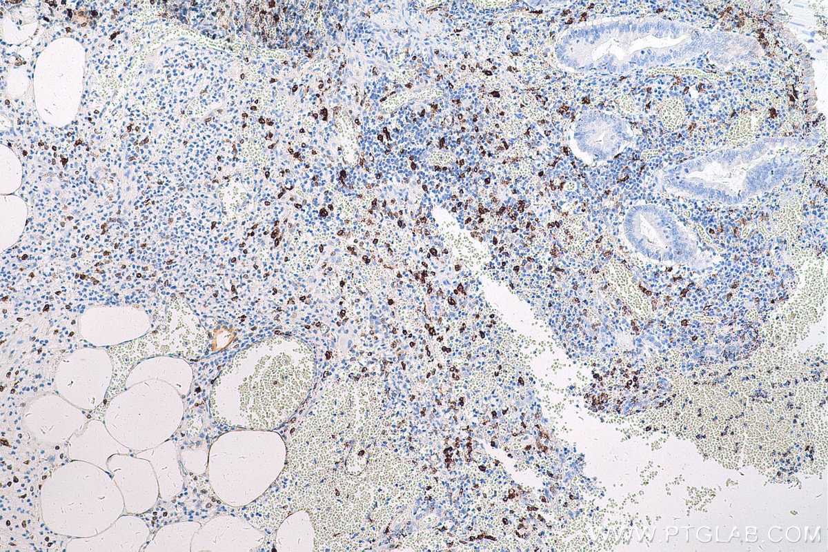 Immunohistochemical analysis of paraffin-embedded human appendicitis tissue slide using KHC0624 (HO-1/HMOX1 IHC Kit).