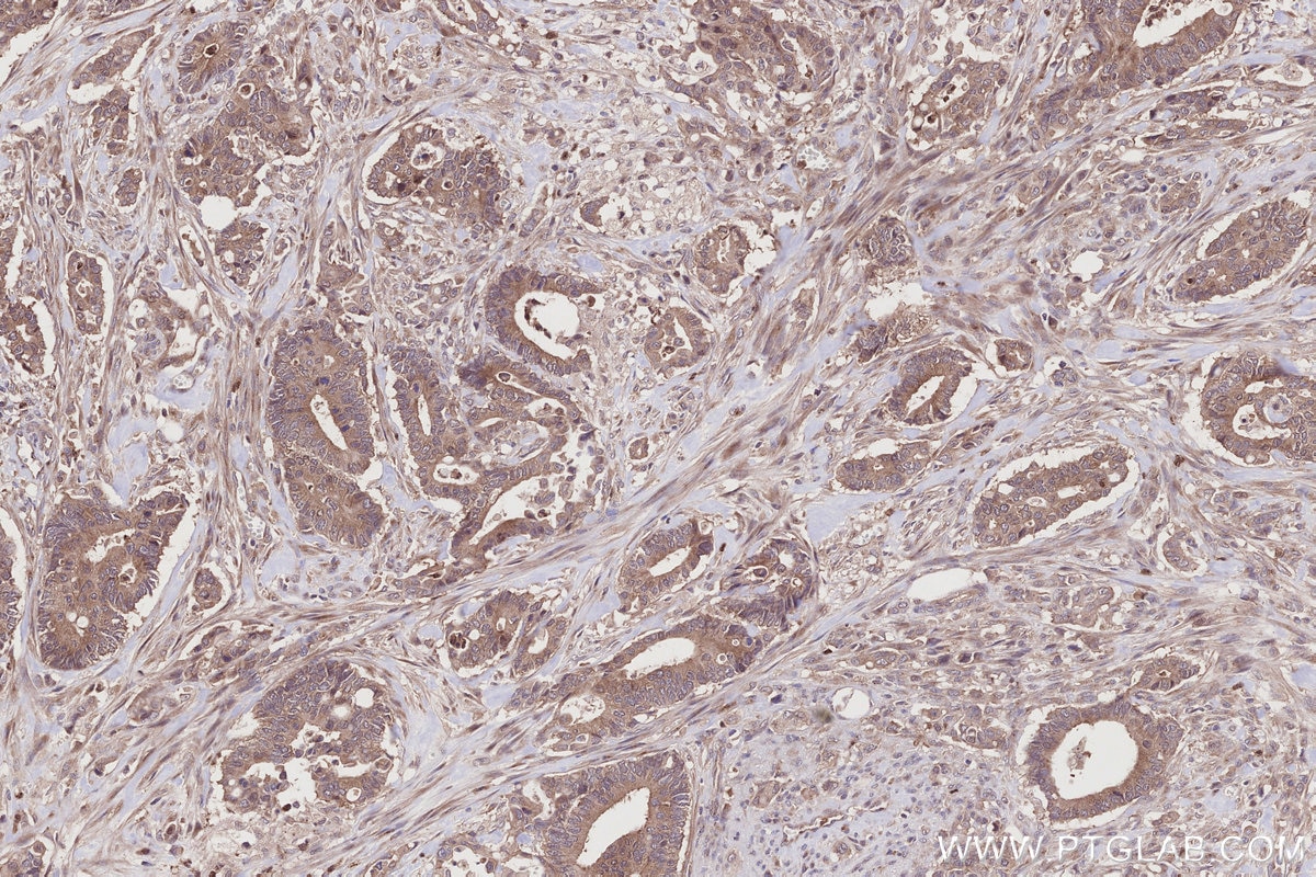 Immunohistochemical analysis of paraffin-embedded human rectal cancer tissue slide using KHC2788 (HOOK2 IHC Kit).