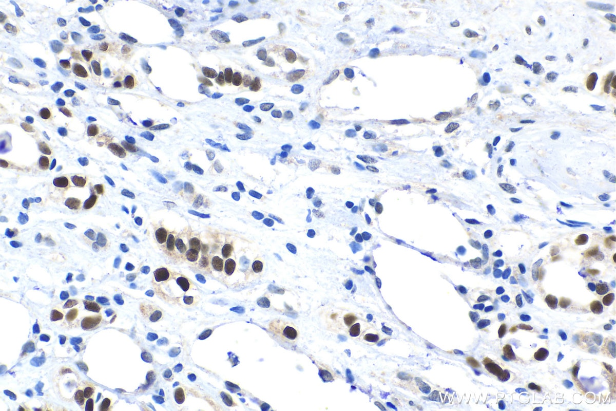 Immunohistochemical analysis of paraffin-embedded human renal cell carcinoma tissue slide using KHC1529 (HOXD8 IHC Kit).