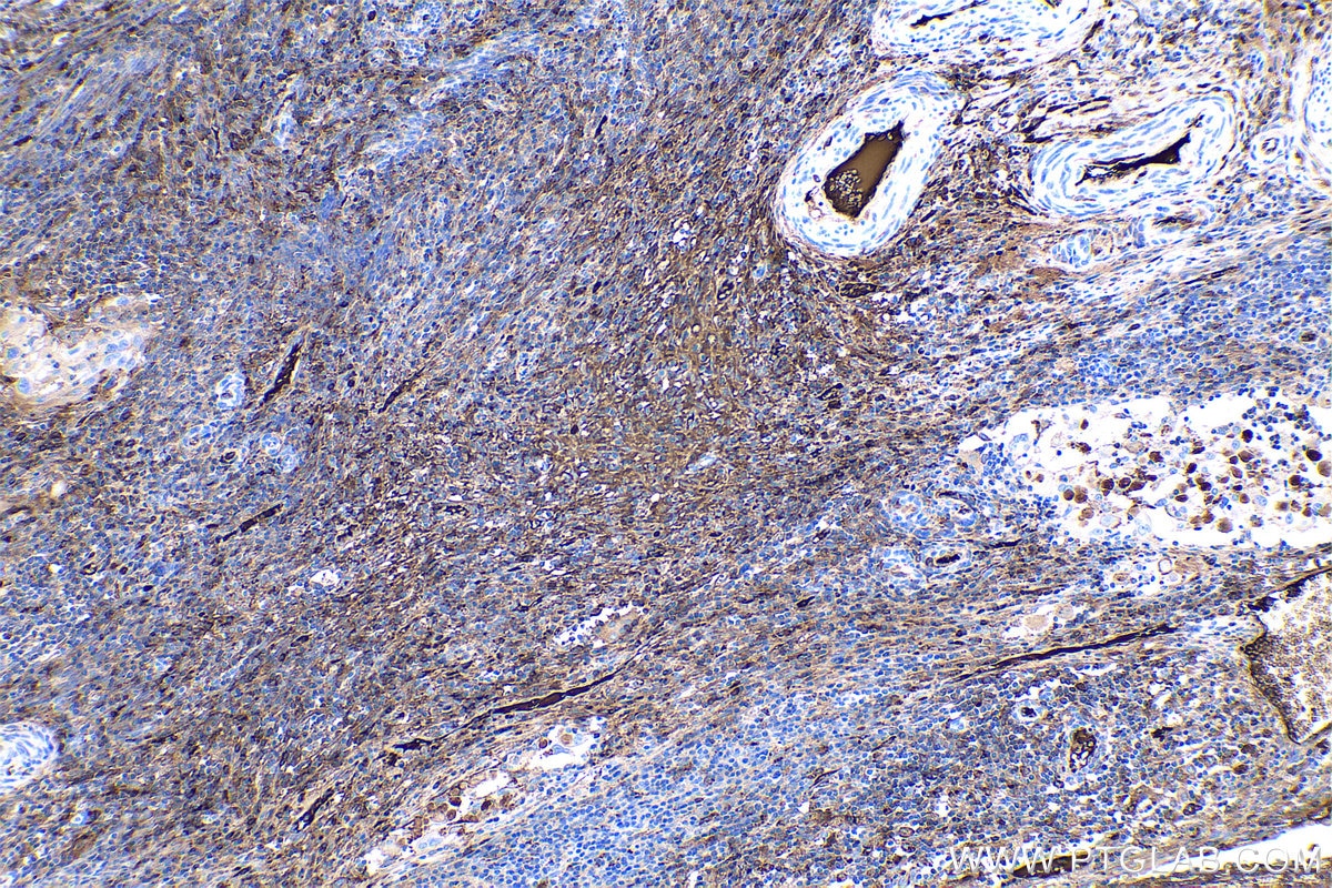 Immunohistochemical analysis of paraffin-embedded human cervical cancer tissue slide using KHC0425 (HP IHC Kit).