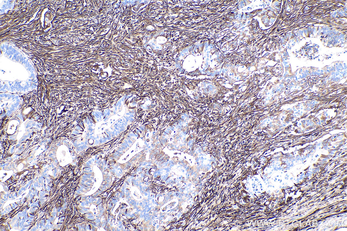 Immunohistochemical analysis of paraffin-embedded human colon cancer tissue slide using KHC0425 (HP IHC Kit).