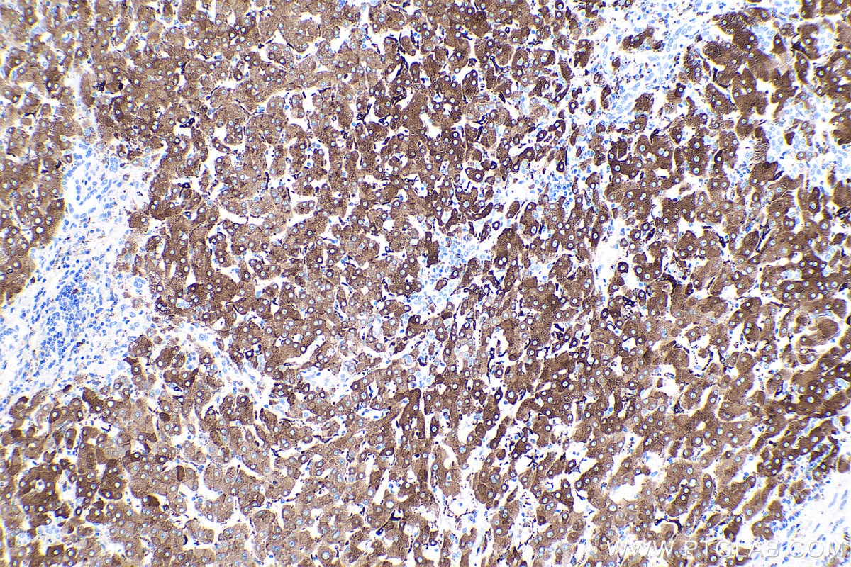 Immunohistochemical analysis of paraffin-embedded human liver cancer tissue slide using KHC0425 (HP IHC Kit).
