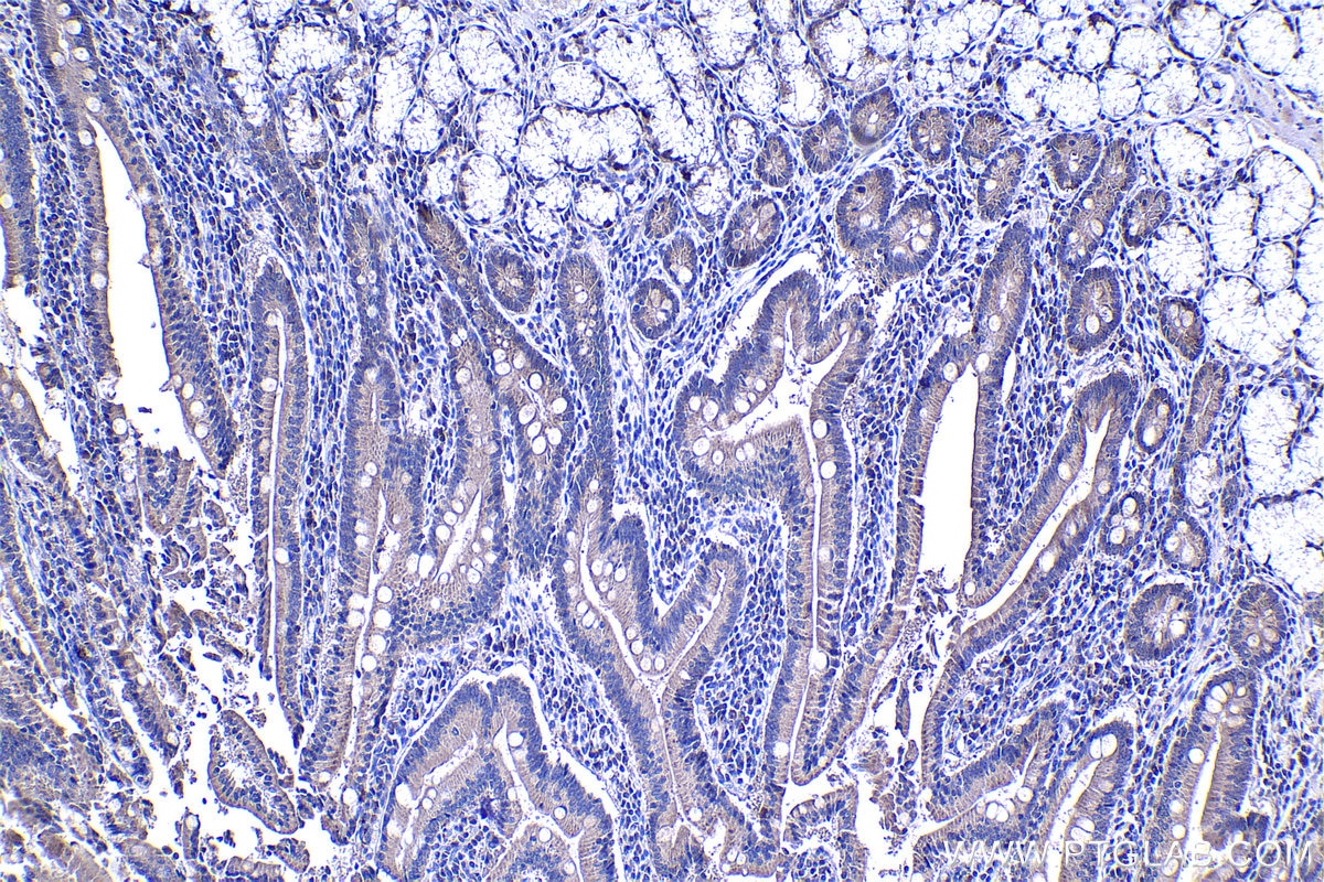 Immunohistochemical analysis of paraffin-embedded human stomach cancer tissue slide using KHC1307 (HPDL IHC Kit).