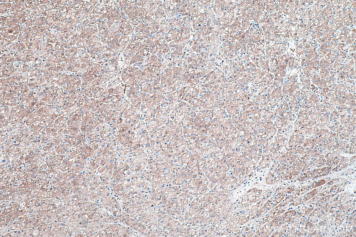 Immunohistochemical analysis of paraffin-embedded human liver cancer tissue slide using KHC0426 (HPRT1 IHC Kit).