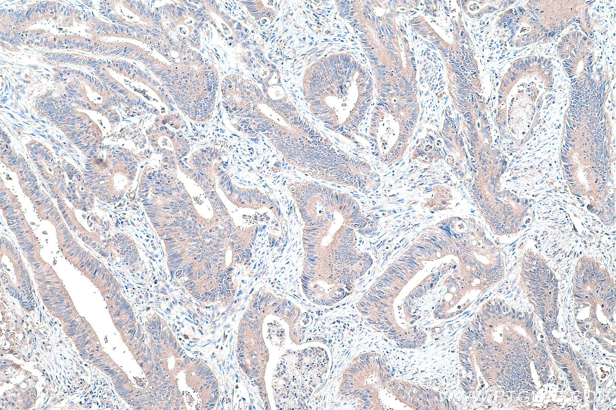 Immunohistochemical analysis of paraffin-embedded human colon cancer tissue slide using KHC0426 (HPRT1 IHC Kit).