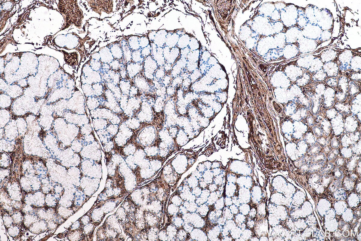 Immunohistochemical analysis of paraffin-embedded human stomach cancer tissue slide using KHC0673 (HPX IHC Kit).