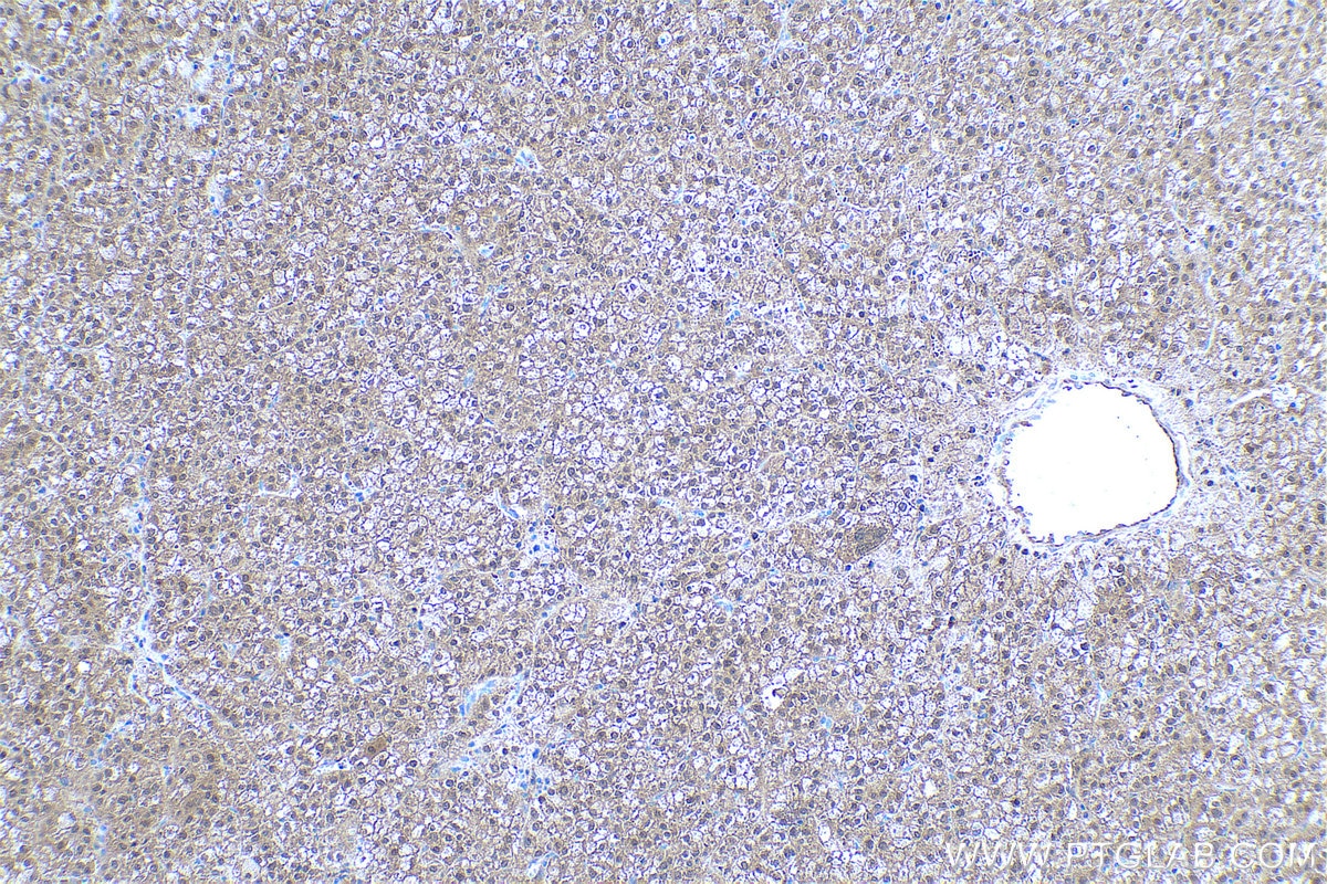 Immunohistochemical analysis of paraffin-embedded human liver cancer tissue slide using KHC0517 (HRSP12 IHC Kit).