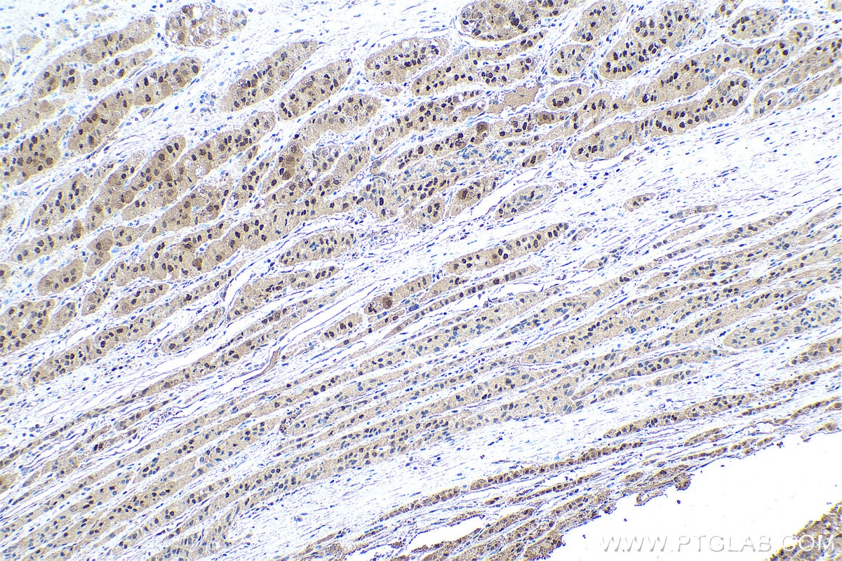 Immunohistochemical analysis of paraffin-embedded human liver cancer tissue slide using KHC0517 (HRSP12 IHC Kit).