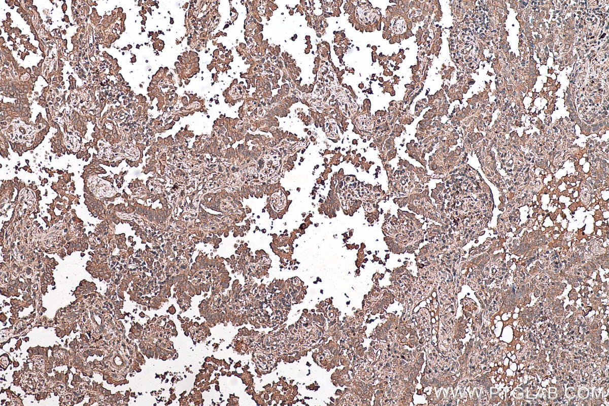 Immunohistochemical analysis of paraffin-embedded human lung cancer tissue slide using KHC0549 (Hsc70 IHC Kit).