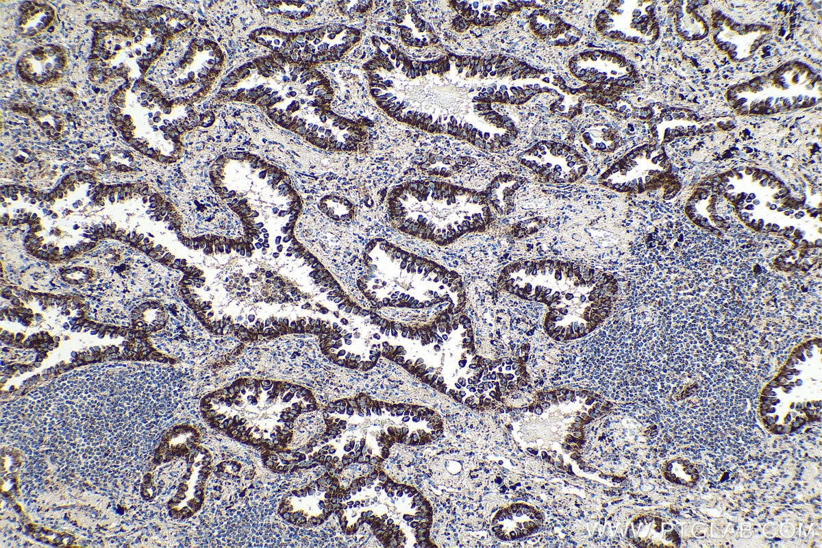 Immunohistochemical analysis of paraffin-embedded human lung cancer tissue slide using KHC0543 (HSD17B10 IHC Kit).