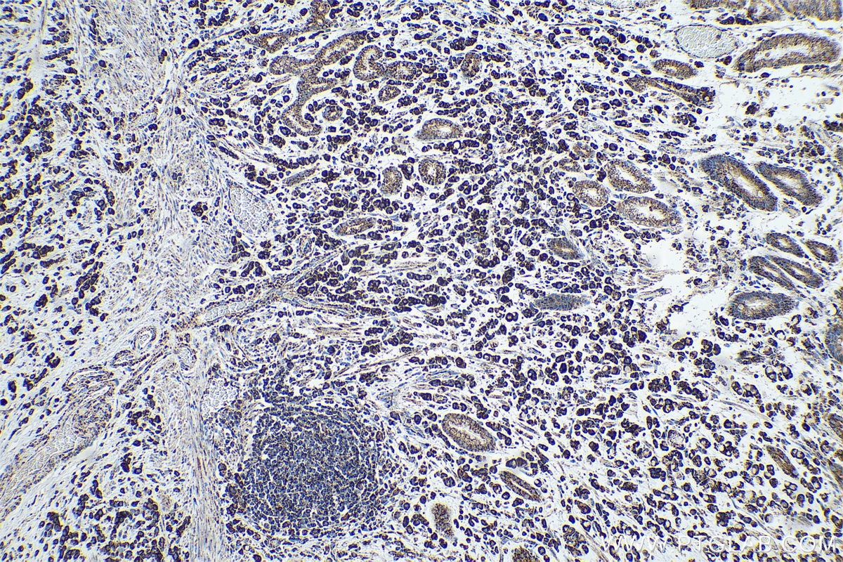 Immunohistochemical analysis of paraffin-embedded human stomach cancer tissue slide using KHC0543 (HSD17B10 IHC Kit).