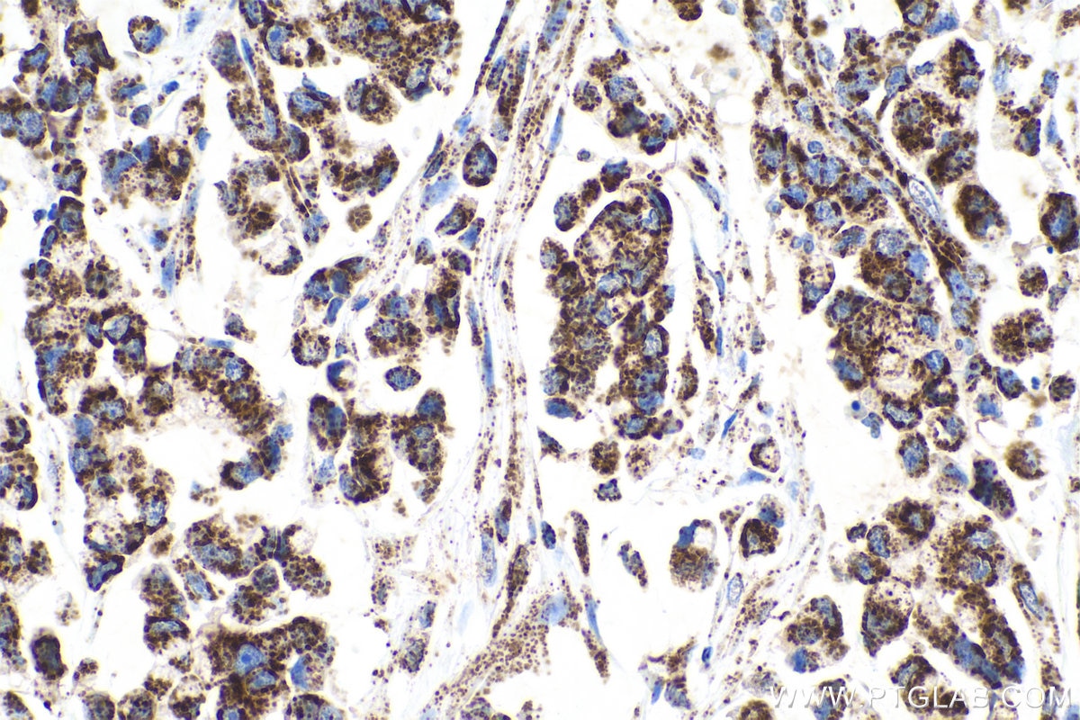 Immunohistochemical analysis of paraffin-embedded human colon cancer tissue slide using KHC0543 (HSD17B10 IHC Kit).